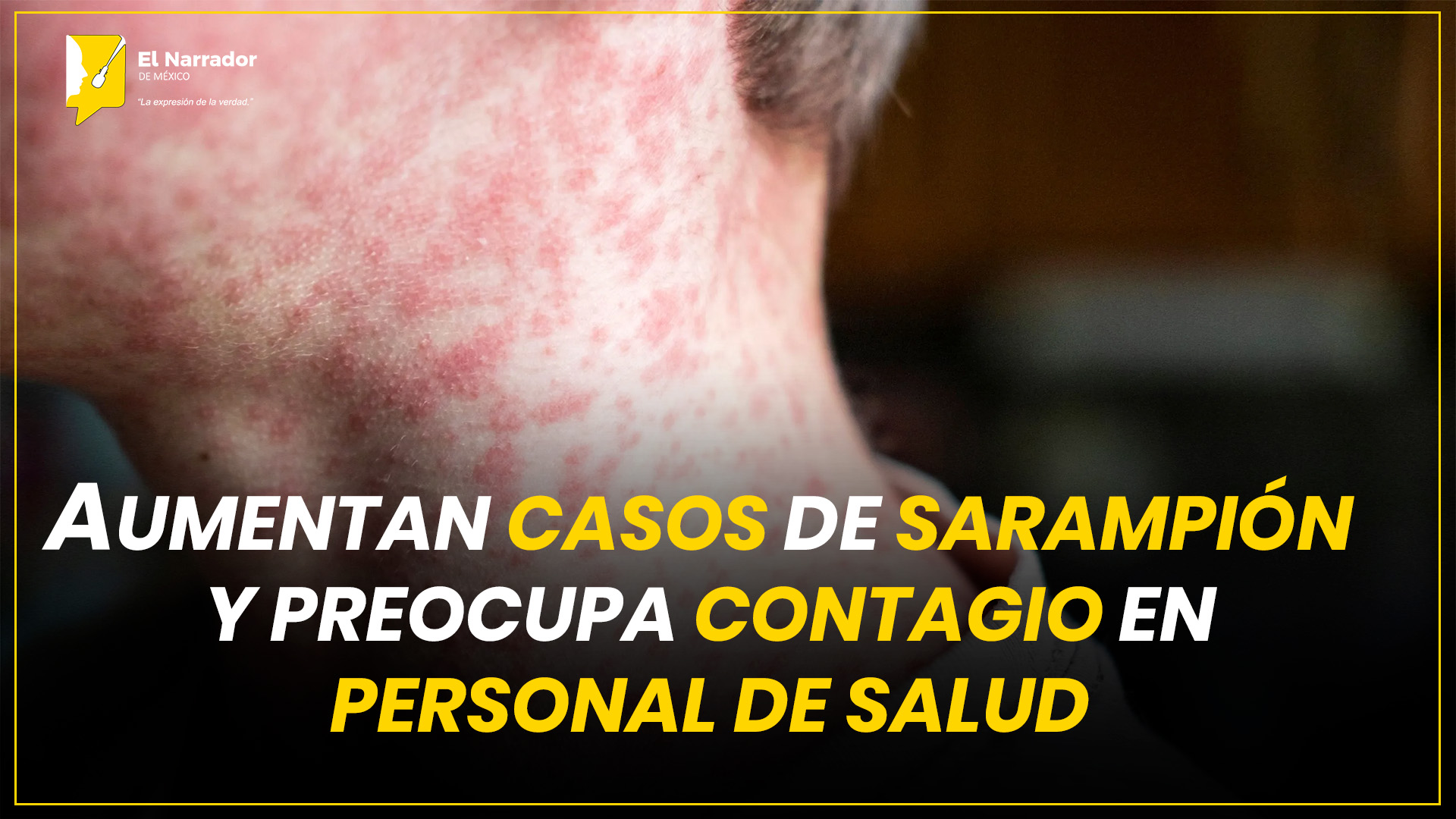 AUMENTAN CASOS DE SARAMPIÓN Y PREOCUPA CONTAGIO EN PERSONAL DE SALUD