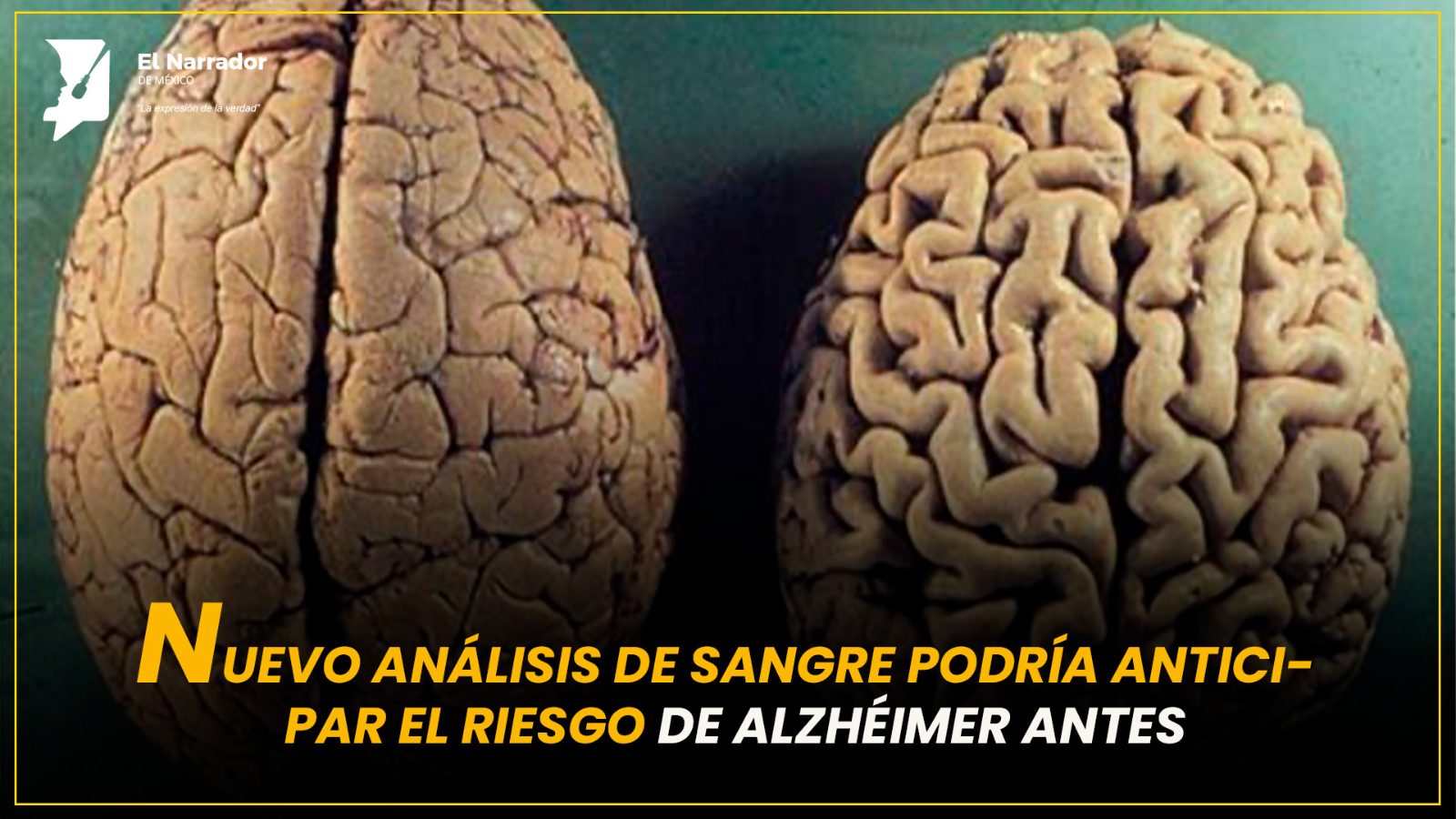 NUEVO ANÁLISIS DE SANGRE PODRÍA ANTICIPAR EL RIESGO DE ALZHÉIMER ANTES